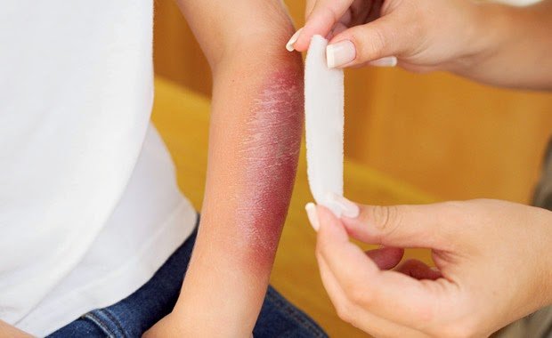 Mơ thấy bị bỏng