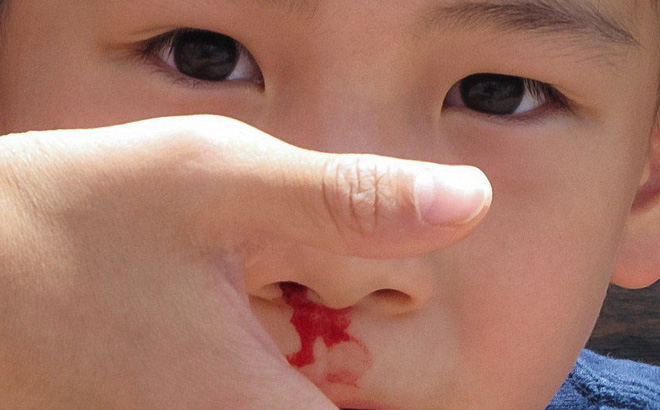 Mơ thấy chảy máu
